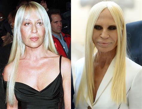 donatella versace before and after surgery.